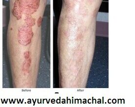 AROGYAM PURE HERBS KIT FOR PSORIASIS